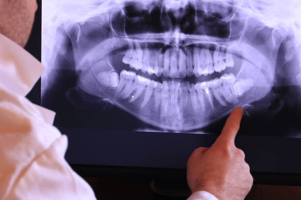 Best Knocked-Out Tooth (Avulsed Tooth) Treatment in Higganum, CT
