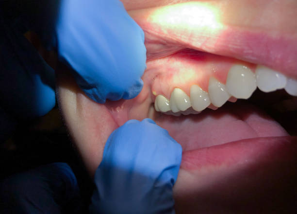 Best Broken or Chipped Tooth Repair in Higganum, CT