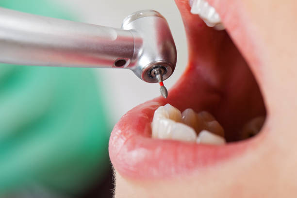 Best Knocked-Out Tooth (Avulsed Tooth) Treatment in Higganum, CT